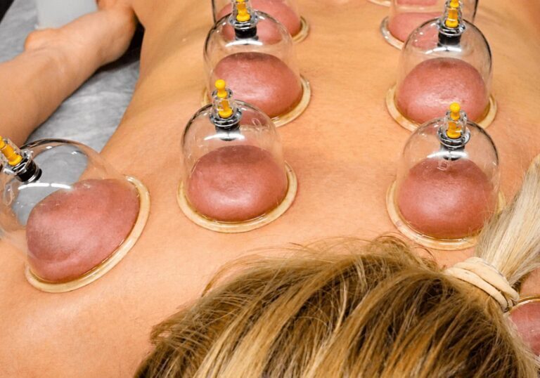 Cupping terapija (VAKUUM TERAPIJA)